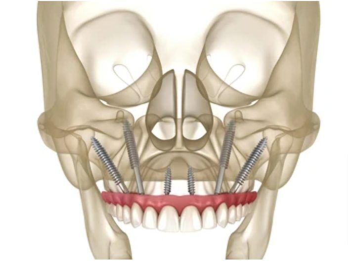 xray showing Zygomatic Implants